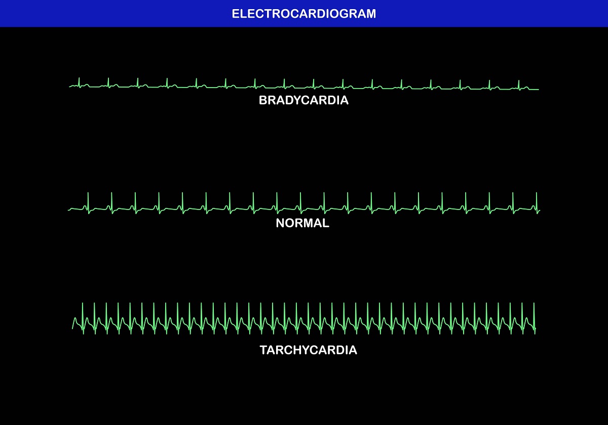 Fyziologická, zrychlená a zpomalená srdeční frekvence na EKG - EKG křivka